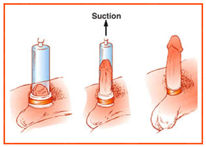 Máy tập penis pump tăng kích thước kéo dài dương vật hiệu quả nhanh